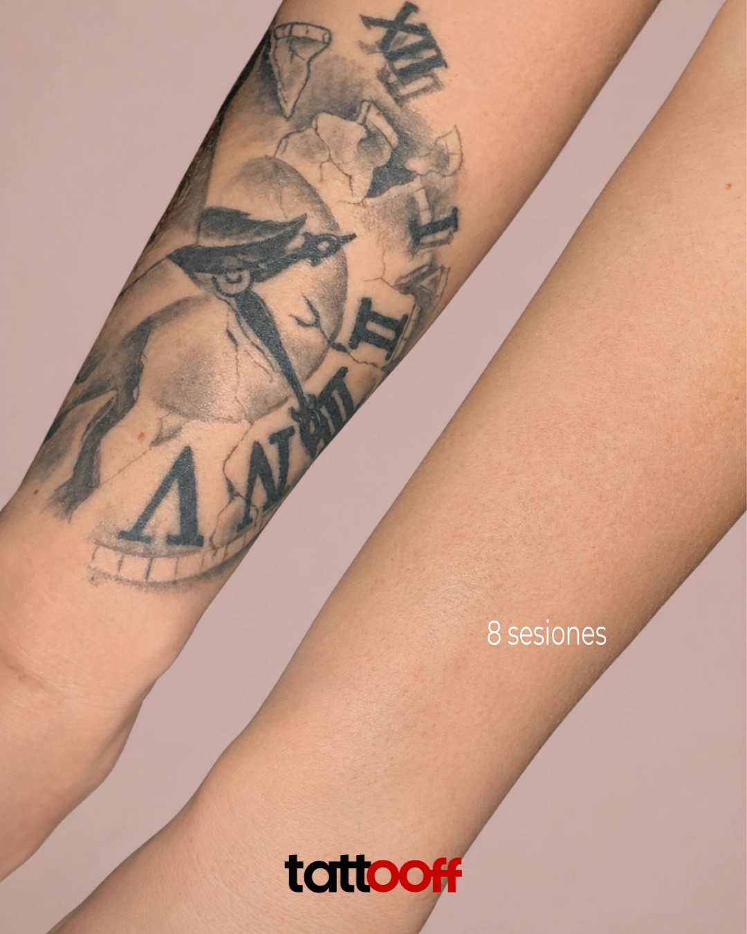 eliminación de tatuaje negro de reloj en antebrazo - antes y después en 8 sesiones - TATTOOFF CDMX