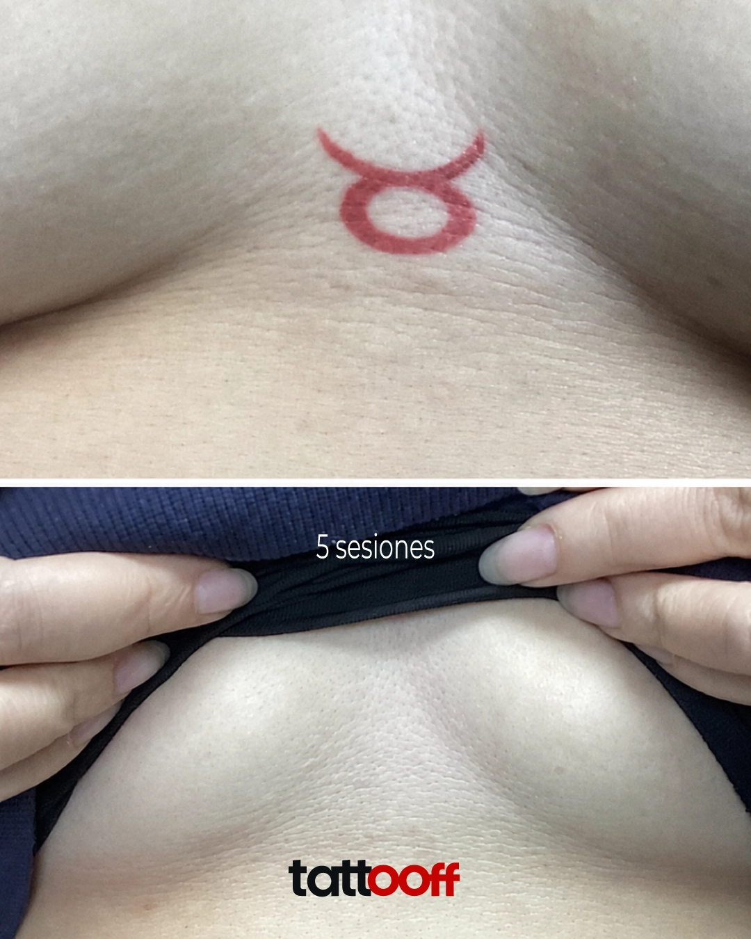 eliminación de tatuaje de tinta roja en pecho - antes y después en 5 sesiones - TATTOOFF CDMX