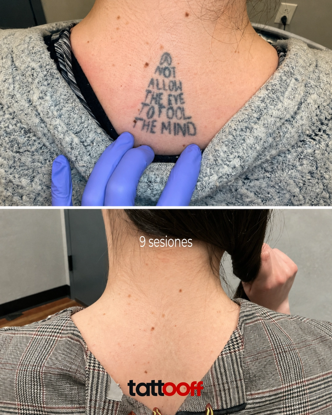 eliminación de tatuaje de texto en nuca - antes y después en 9 sesiones - TATTOOFF CDMX