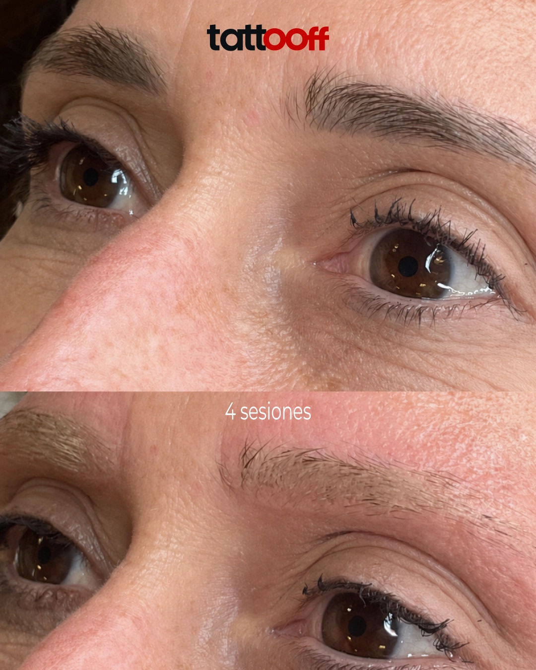 aclaramiento de micropigmentación de cejas - antes y después en 4 sesiones - TATTOOFF CDMX